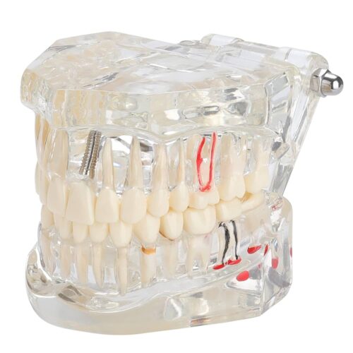 Implant Cast Model -Clear