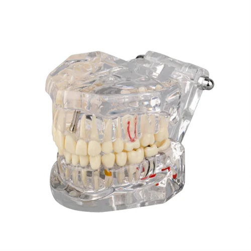 Implant Cast Model -شفاف